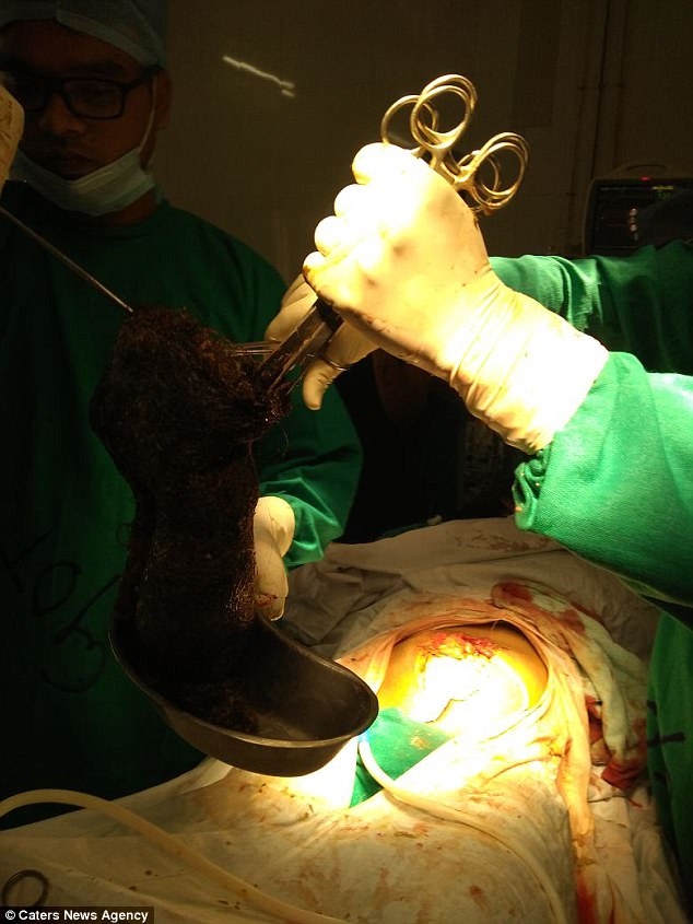 Tuong bien chung sau sinh, bac si bat ngo voi 1,5kg toc trong ruot san phu
