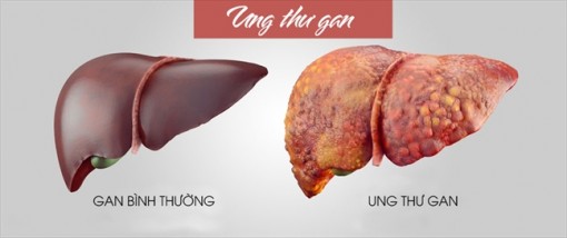 Dinh dưỡng cho bệnh nhân ung thư gan giai đoạn cuối
