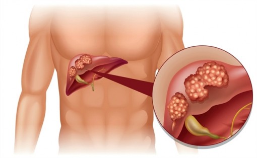 Cách nhận biết ung thư gan