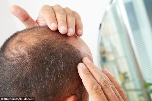 Nam giới bạc tóc và hói đầu sớm trước 40 tuổi dễ bị bệnh gì nhất?