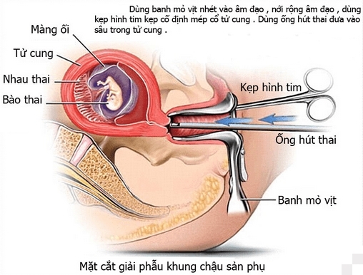 Vu triet san roi van co thai: Benh nhan quen loi dan cua bac si?