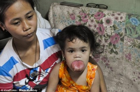 Bé gái 2 tuổi có nguy cơ chết ngạt vì lưỡi phình quá to
