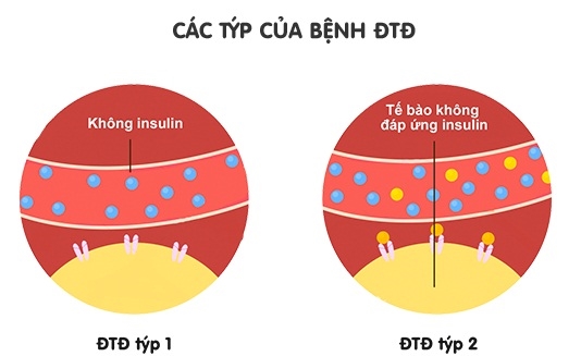 Doi dieu ve an uong va benh dai thao duong