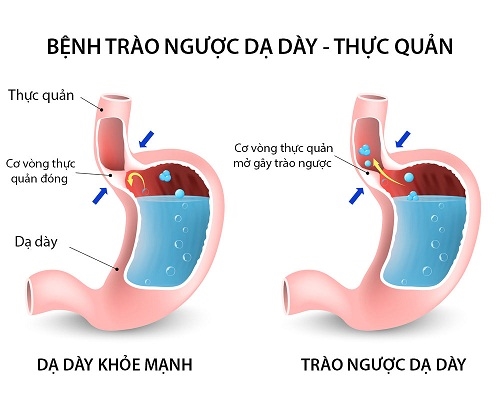 Benh trao nguoc da day - thuc quan lam tang nguy co ung thu hong, amidan, xoang