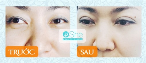 Sở hữu mắt 2 mí quyến rũ với phương pháp an toàn Eyelid Shape