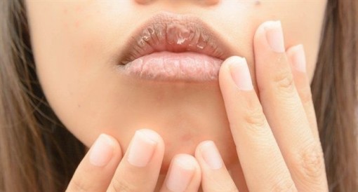 Cách trị môi khô bong tróc mùa lạnh đơn giản nhất