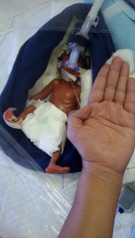 Em bé sinh non nặng 0,4kg, nhỏ bằng bàn tay mẹ, sống sót kỳ diệu