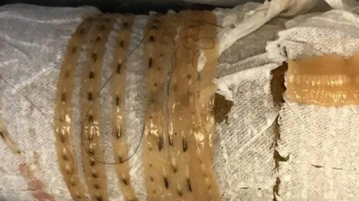 Sán dây gần 1,7m sống trong cơ thể người đàn ông thích ăn sushi