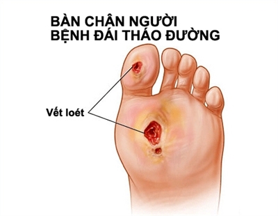 8 nguyen nhan khien vet thuong kho lanh