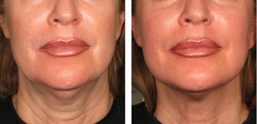 Làm đẹp với Ultherapy – Cần thận trọng “chọn mặt gửi vàng”