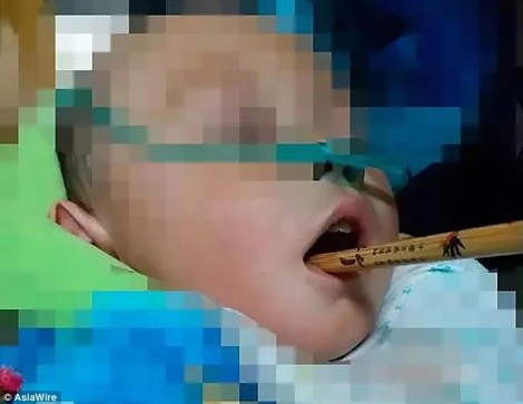Bé trai 2 tuổi thủng não vì ngậm đũa chạy chơi trong nhà