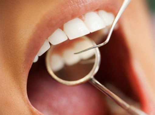 Người bị tim mạch có thể tử vong vì bệnh răng miệng