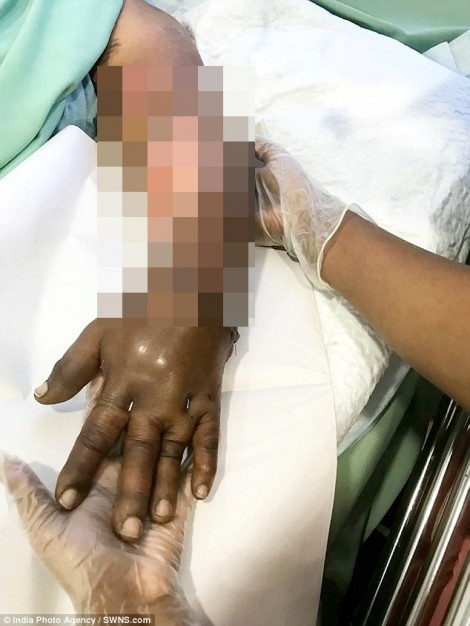 Một phụ nữ đứt lìa bàn tay do máy cắt dừa