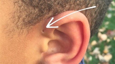 Vì sao một số người có lỗ nhỏ trên vành tai?