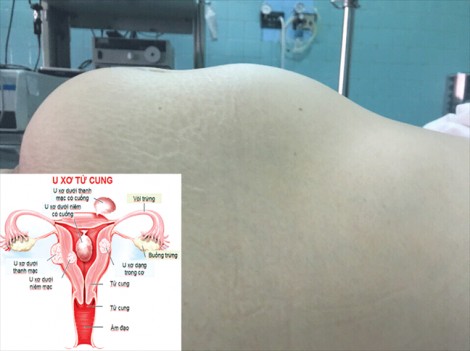Đi khám vì mệt, một phụ nữ ở Ninh Thuận phát hiện khối u 5kg trong người