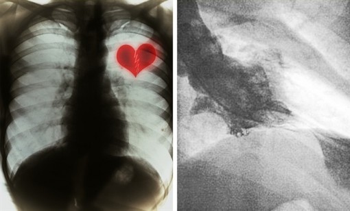 6 căn bệnh cơ thể phải gánh chịu vì tình yêu