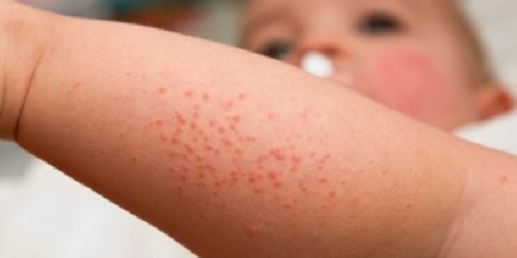 Tại sao sốt phát ban ở trẻ em một tuần chưa lặn?