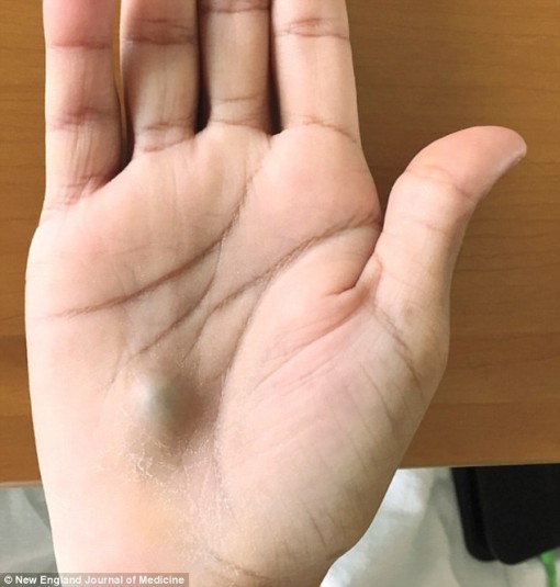 Nổi cục u ở lòng bàn tay, bệnh nhân được chẩn đoán bệnh chết người