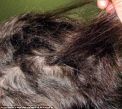 Hai phụ nữ bị rụng lông tóc sau khi ăn bí