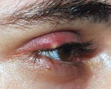 Cảnh báo dịch đau mắt đỏ vào mùa