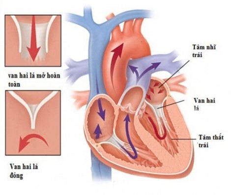 Thay van tim bằng phương pháp nào tốt nhất?