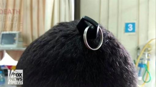 Chìa khóa xe đâm xuyên sọ thanh niên 19 tuổi