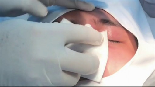 Chàng trai 24 tuổi mất hết da mũi sau khi tiêm filler ở spa