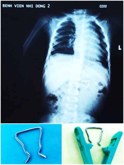 Hai bệnh viện ở TP.HCM phối hợp gắp đoạn kẽm trong bụng bé trai