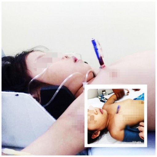 Chạy chơi vấp té, bé gái 4 tuổi bị bút bi đâm xuyên ngực