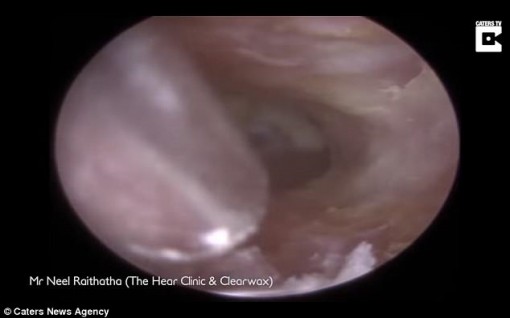 Một phụ nữ mất thính lực vì có quá nhiều ráy tai