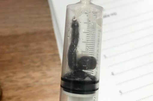 Tắm và uống nước suối ở Nghệ An bị vắt chui vào mũi sống gần 1 tháng