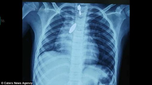 Hút nam châm mắc kẹt trong phổi bé gái 9 tuổi không cần mổ