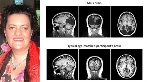 Bệnh lạ khiến người phụ nữ chỉ thấy được vật thể chuyển động