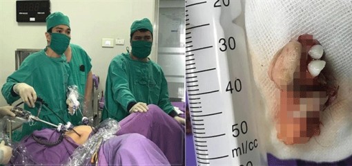 Bé gái 12 tuổi đã bị u quái buồng trứng