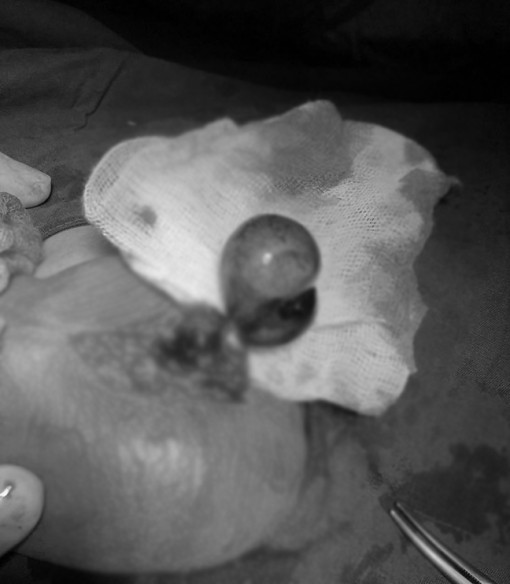 Bé trai 2 ngày tuổi bị hoại tử tinh hoàn