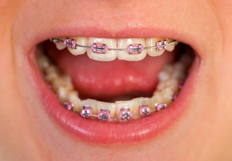Cần cân nhắc kỹ trước khi niềng răng cho trẻ