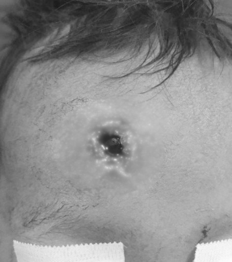 Bé trai 33 tháng tuổi bị đạn găm xuyên trán
