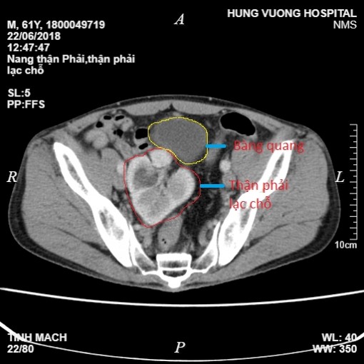 Đau bụng âm ỉ, đi siêu âm mới biết thận nằm sai chỗ suốt 61 năm
