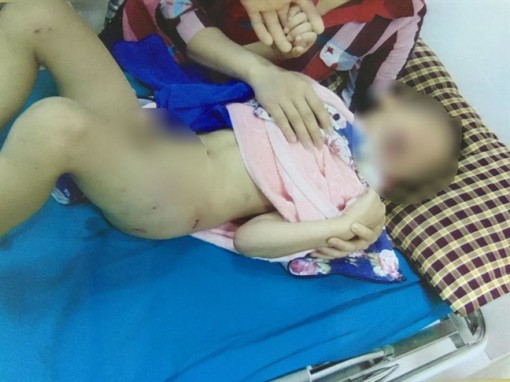 Bé 6 tuổi bị chó cắn rách mông và đùi khi đùa với bạn