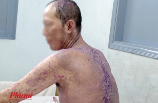 Người đàn ông ở TP.HCM như bị bỏng lửa sau khi uống thuốc