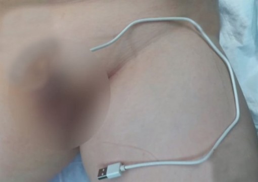 Giải cứu bé trai nhét dây cáp USB dài 20cm vào dương vật