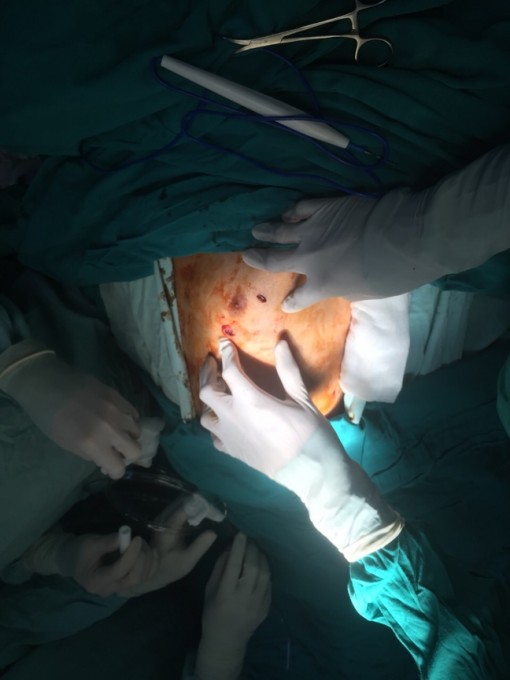 Chờ mổ ở Bệnh viện Chấn thương chỉnh hình, bệnh nhân tự đâm mình 4 nhát