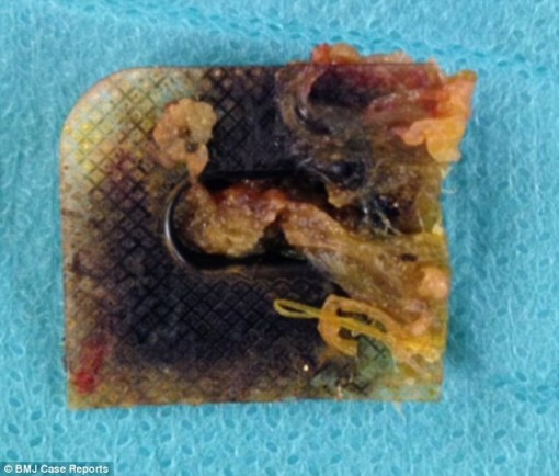 Nuốt vỉ thuốc, cắt bỏ 30cm ruột