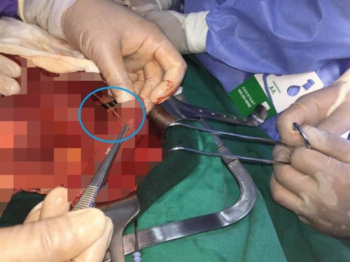 Cụ ông 72 tuổi tắc ruột do ngậm tăm xỉa răng khi đi ngủ