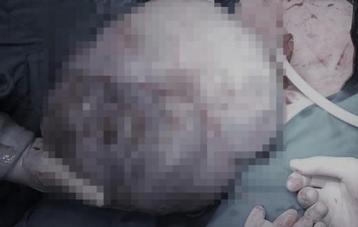 Phát hiện u buồng trứng 6,2kg do chủ quan không đi khám bệnh