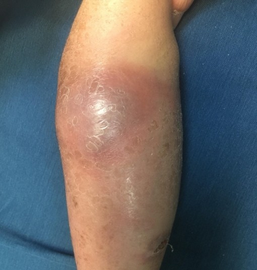 Bé gái 5 tuổi hoại tử xương sau khi đắp lá chữa gãy tay