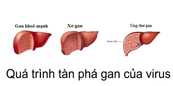 Hon 90% nguoi nhiem viem gan B, C khong biet minh mac benh