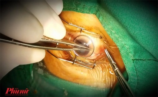 Hai phụ nữ sáng mắt sau ca phẫu thuật 'nín thở' ở Bệnh viện Chợ Rẫy