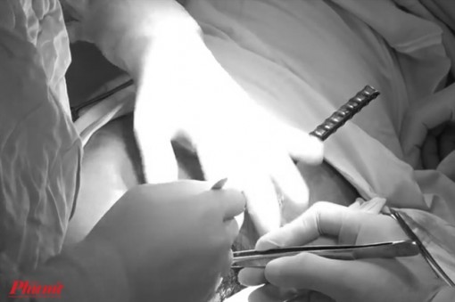 Cấp cứu thành công người đàn ông bị hai thanh sắt đâm xuyên người