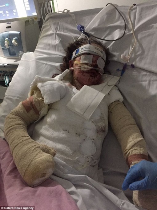 Bé gái bỏng 65% cơ thể và mất trí nhớ sau khi uống thuốc giảm đau